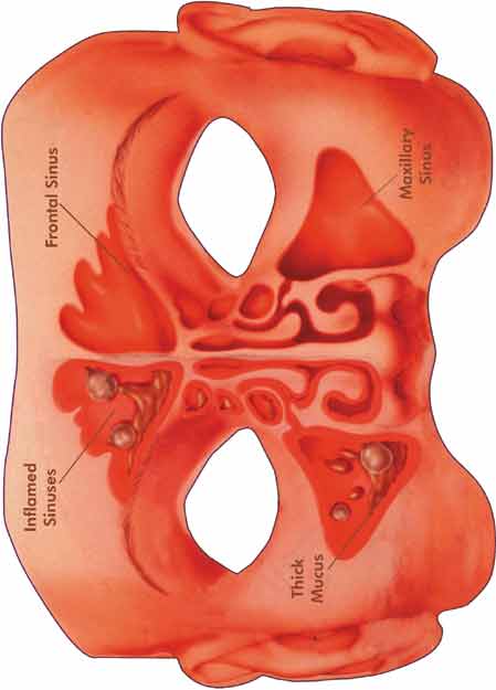 Sinus Mask