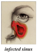 infected sinus
